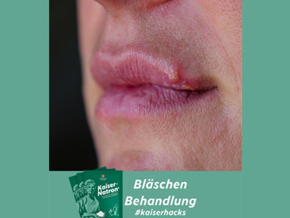 Lippen-Bläschen
